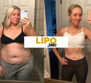 imgi_8_lipodep1-scaled-1.png